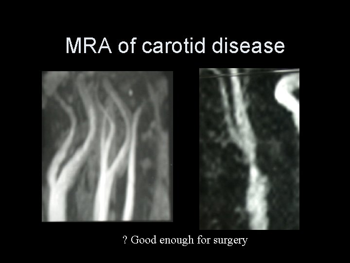MRA of carotid disease ? Good enough for surgery 
