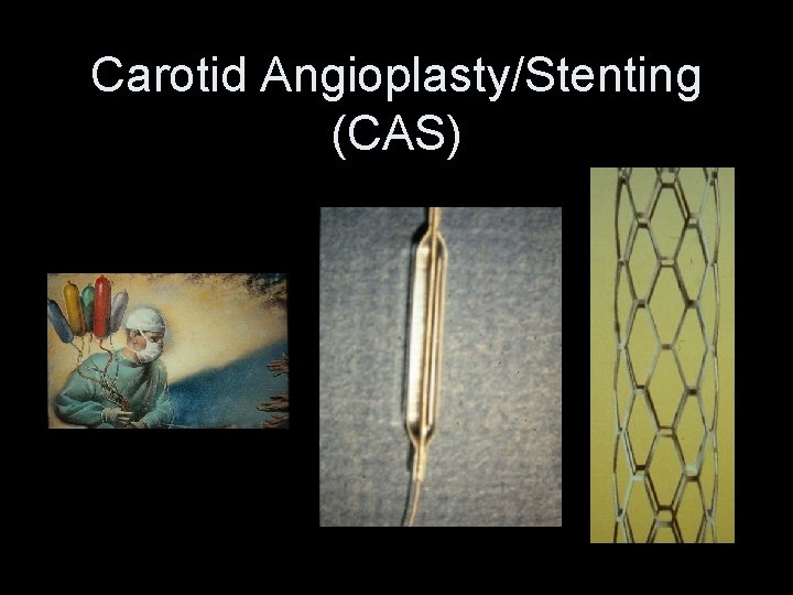 Carotid Angioplasty/Stenting (CAS) 