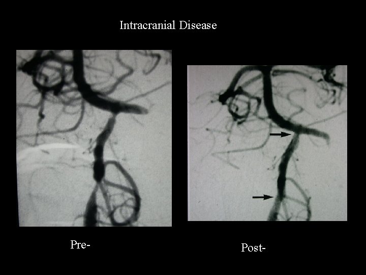 Intracranial Disease Pre- Post- 