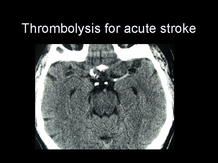 Thrombolysis for acute stroke 