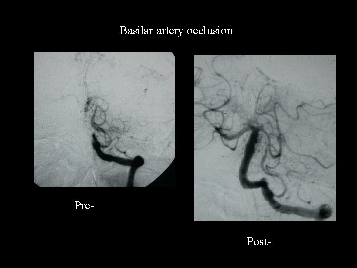 Basilar artery occlusion Pre. Post- 