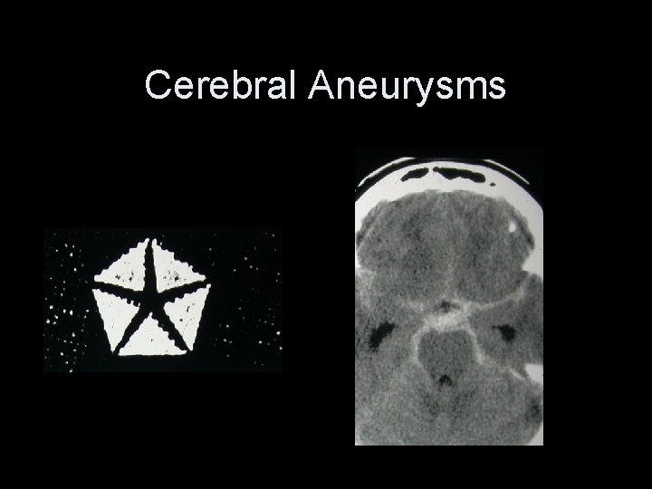 Cerebral Aneurysms 