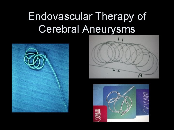 Endovascular Therapy of Cerebral Aneurysms 