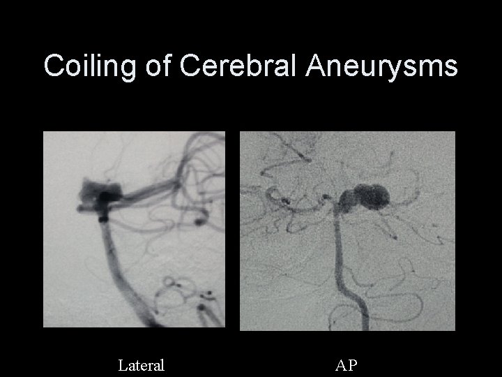 Coiling of Cerebral Aneurysms Lateral AP 