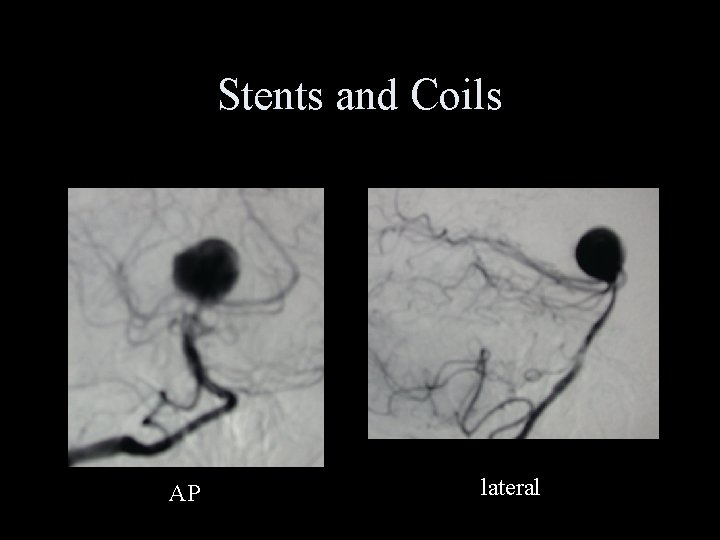 Stents and Coils AP lateral 