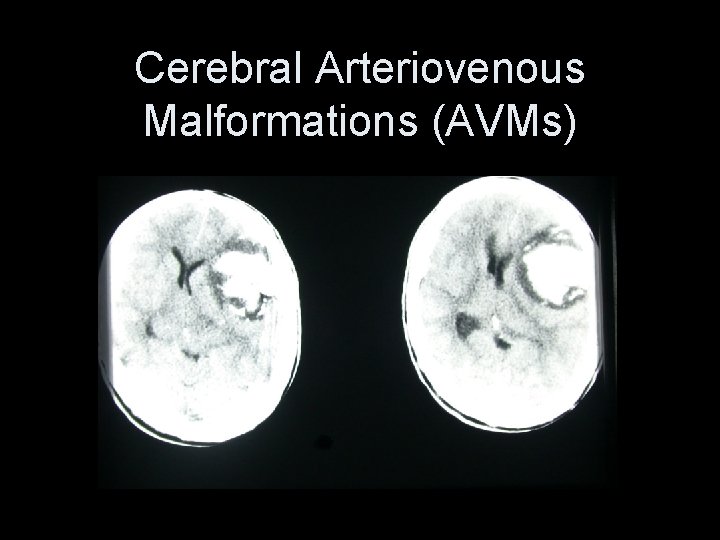 Cerebral Arteriovenous Malformations (AVMs) 