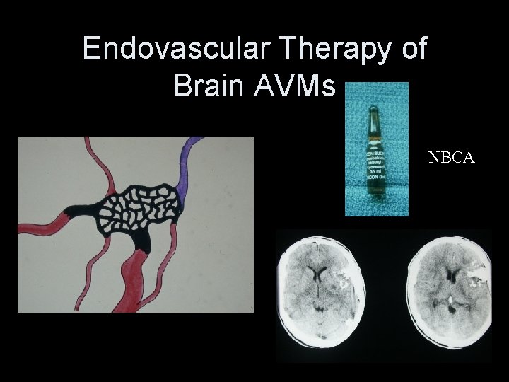 Endovascular Therapy of Brain AVMs NBCA 