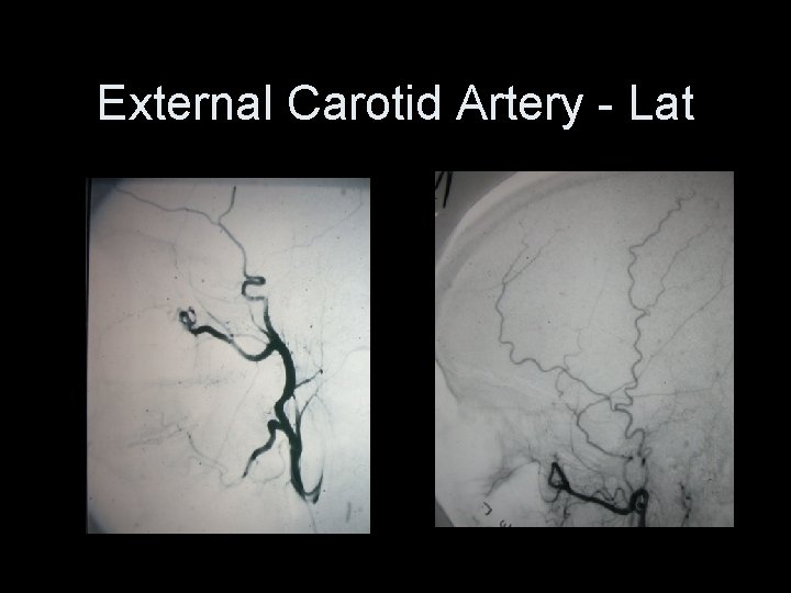 External Carotid Artery - Lat 
