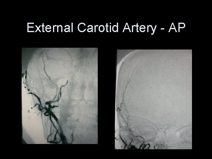 External Carotid Artery - AP 