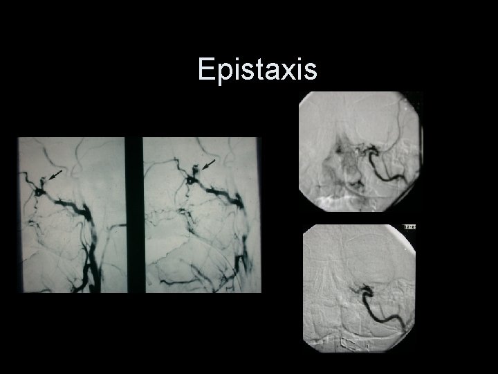 Epistaxis 