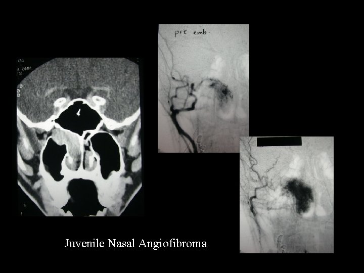 Juvenile Nasal Angiofibroma 