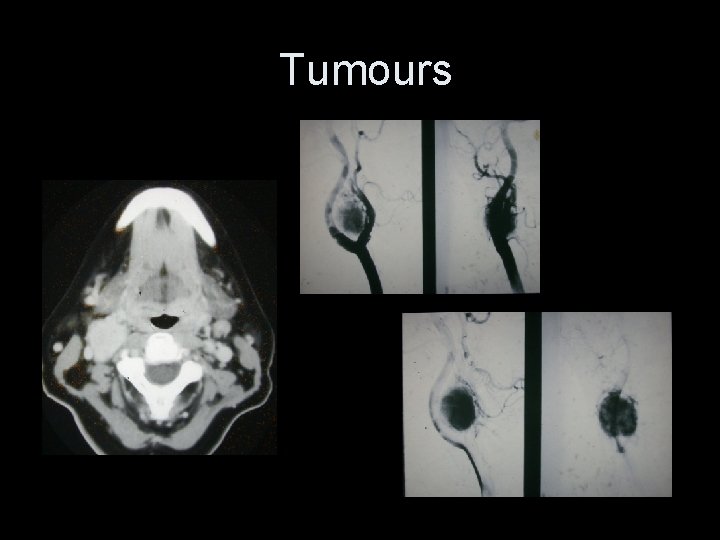Tumours 