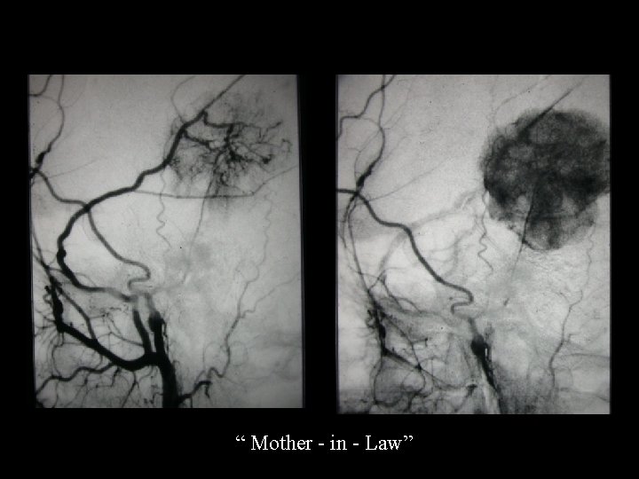 “ Mother - in - Law” 