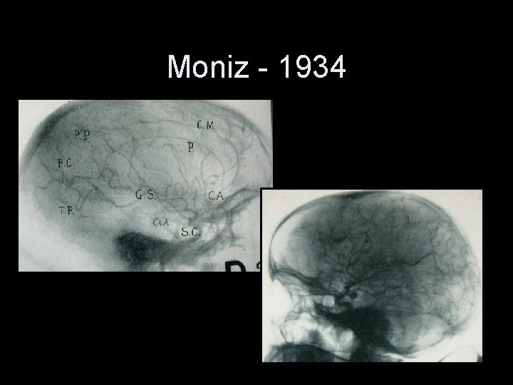 Moniz - 1934 