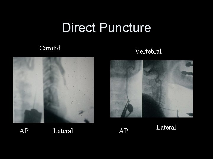 Direct Puncture Carotid AP Lateral Vertebral AP Lateral 