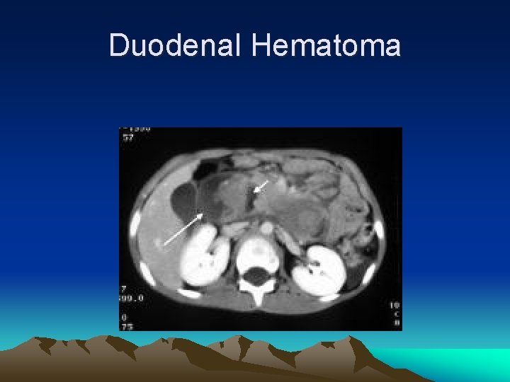 Duodenal Hematoma 