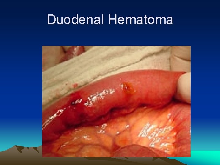 Duodenal Hematoma 
