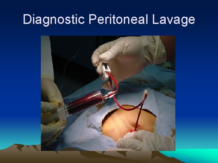 Diagnostic Peritoneal Lavage 