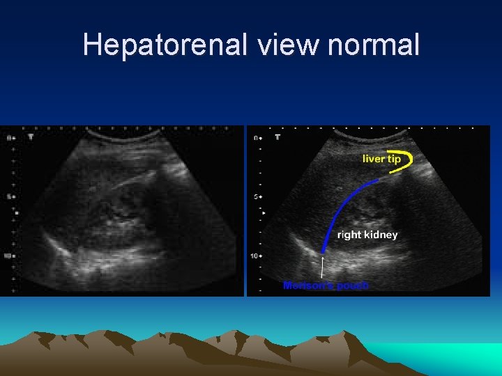 Hepatorenal view normal 