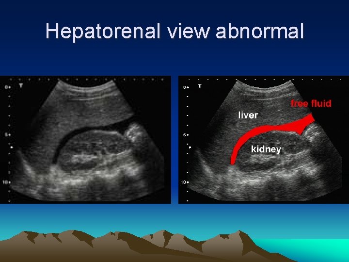 Hepatorenal view abnormal 