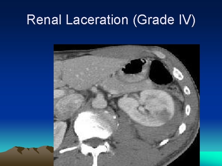 Renal Laceration (Grade IV) 