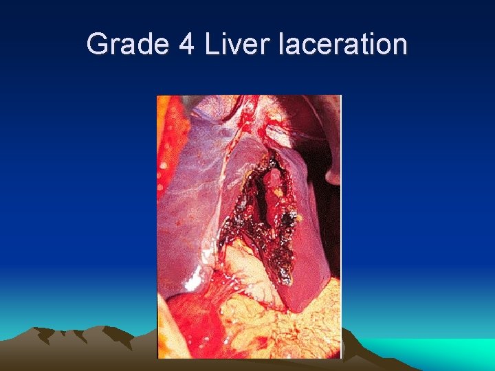 Grade 4 Liver laceration 