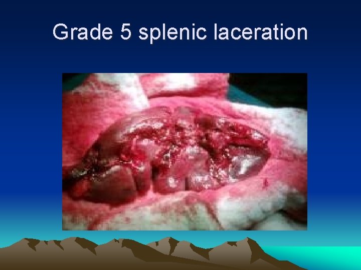 Grade 5 splenic laceration 