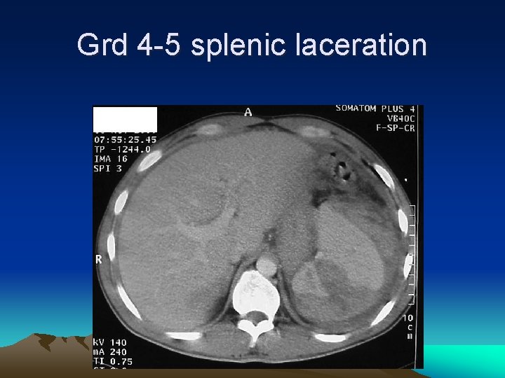 Grd 4 -5 splenic laceration 