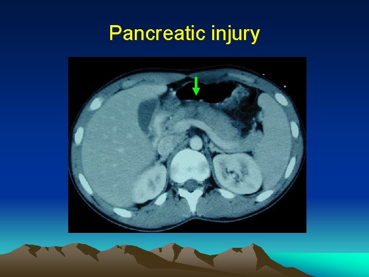 Pancreatic injury 