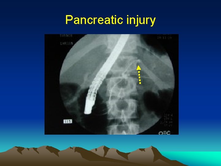 Pancreatic injury 