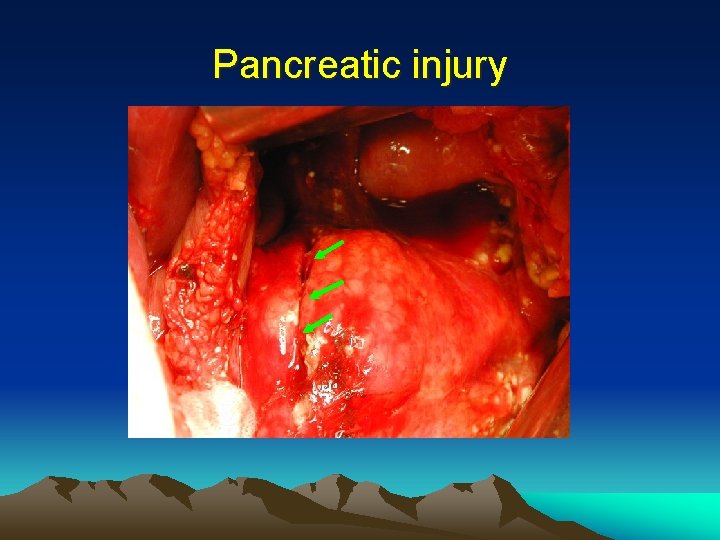 Pancreatic injury 