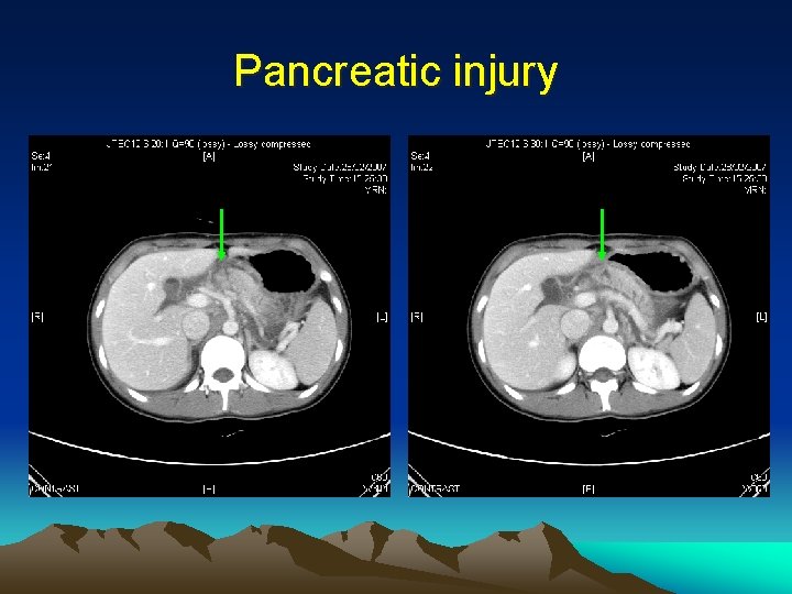 Pancreatic injury 