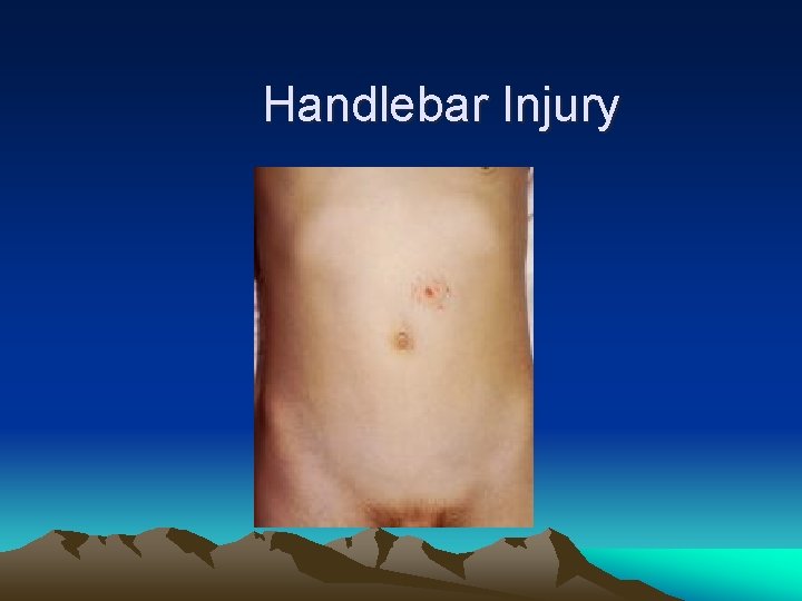 Handlebar Injury 
