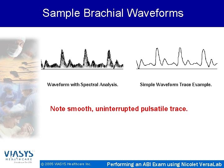 Sample Brachial Waveforms Waveform with Spectral Analysis. Simple Waveform Trace Example. Note smooth, uninterrupted