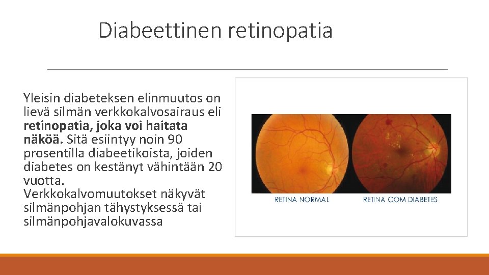 Diabeettinen retinopatia Yleisin diabeteksen elinmuutos on lievä silmän verkkokalvosairaus eli retinopatia, joka voi haitata