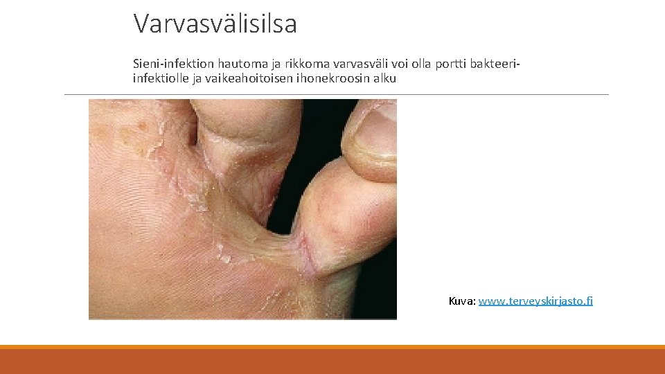 Varvasvälisilsa Sieni-infektion hautoma ja rikkoma varvasväli voi olla portti bakteeriinfektiolle ja vaikeahoitoisen ihonekroosin alku
