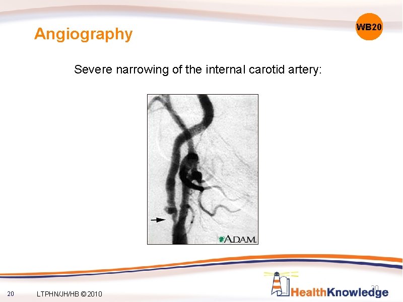 Angiography WB 20 Severe narrowing of the internal carotid artery: 20 LTPHN/JH/HB © 2010