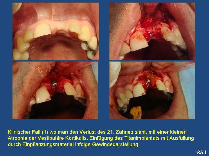 Klinischer Fall (1) wo man den Verlust des 21. Zahnes sieht, mit einer kleinen