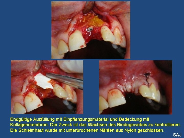 Endgültige Ausfüllung mit Einpflanzungsmaterial und Bedeckung mit Kollagenmembran. Der Zweck ist das Wachsen des