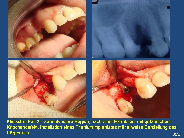 Klinischer Fall 2 – zahnalveolare Region, nach einer Extraktion, mit gefährlichem Knochendefekt. Installation eines