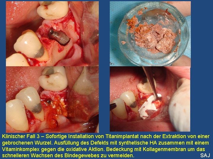 Klinischer Fall 3 – Sofortige Installation von Titanimplantat nach der Extraktion von einer gebrochenen