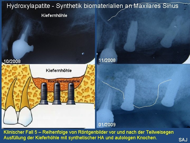 Hydroxylapatite - Synthetik biomaterialien an Maxilares Sinus Kiefernhöhle 11/2008 10/2008 Kiefernhöhle 12/2008 01/2009 Klinischer
