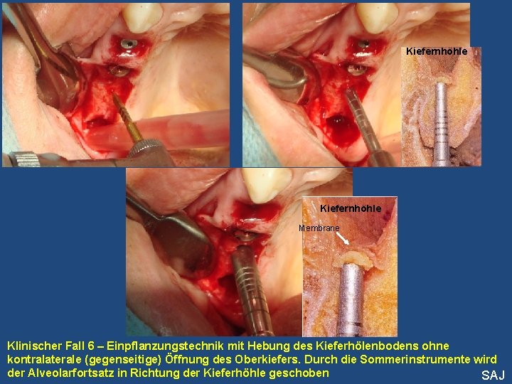 Kiefernhöhle Membrane Klinischer Fall 6 – Einpflanzungstechnik mit Hebung des Kieferhölenbodens ohne kontralaterale (gegenseitige)