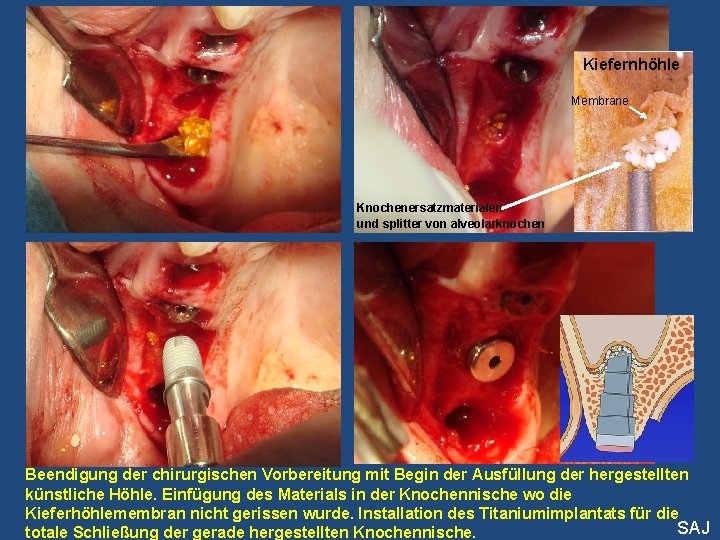 Kiefernhöhle Membrane Knochenersatzmaterialen und splitter von alveolarknochen Beendigung der chirurgischen Vorbereitung mit Begin der