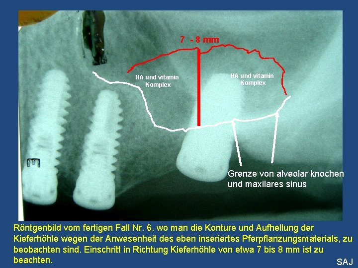 7 - 8 mm HA und vitamin Komplex Grenze von alveolar knochen und maxilares