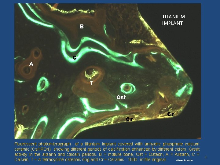 TITANIUM IMPLANT B A C T Ost Cr Cr Fluorescent photomicrograph of a titanium