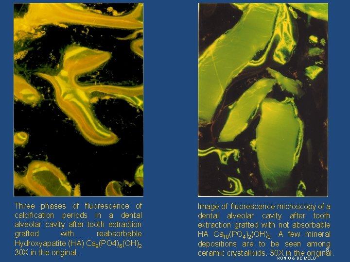 Three phases of fluorescence of calcification periods in a dental alveolar cavity after tooth