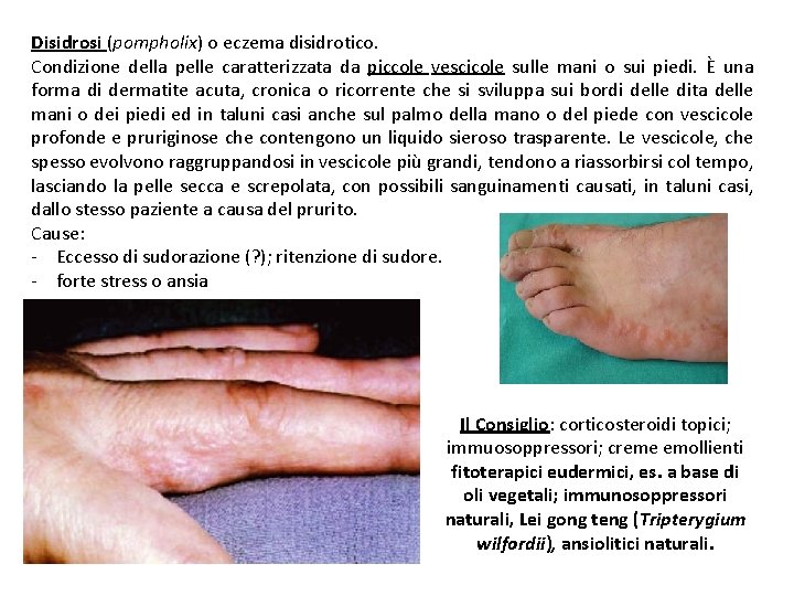 Disidrosi (pompholix) o eczema disidrotico. Condizione della pelle caratterizzata da piccole vescicole sulle mani