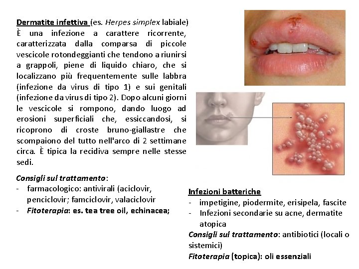 Dermatite infettiva (es. Herpes simplex labiale) È una infezione a carattere ricorrente, caratterizzata dalla