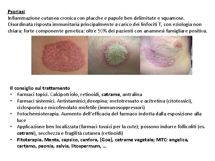 Psoriasi Infiammazione cutanea cronica con placche e papule ben delimitate e squamose. Disordinata risposta
